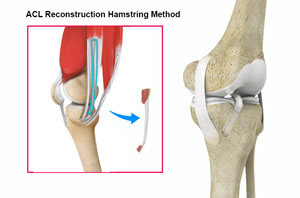 ACL Reconstruction Procedure - Hamstring Tendon