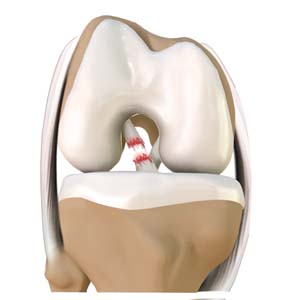 Anterior Cruciate Ligament (ACL) Tears