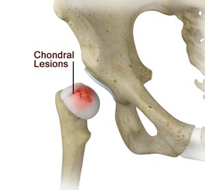Chondral Lesions/Injuries