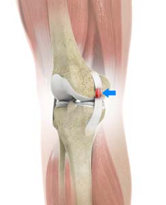 Medial Collateral Ligament (MCL) Sprain