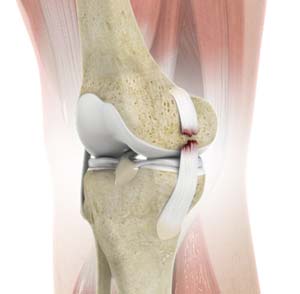 Medial Collateral Ligament (MCL) Tears