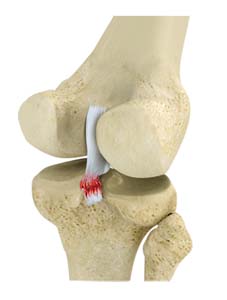 Posterior Cruciate Ligament (PCL) Injuries