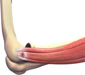 Lateral Epicondylitis (Tennis Elbow)