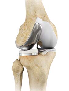 Unicompartmental Knee Replacement(Partial Knee Replacement)